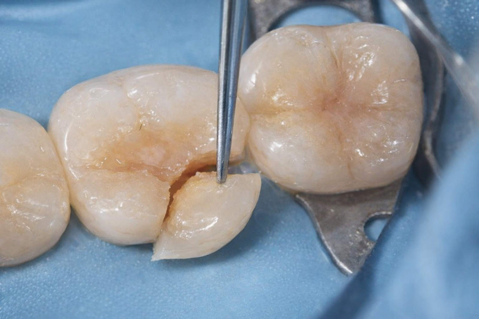 미세균열 CTS와 충치 비교